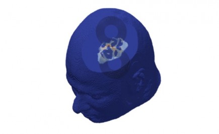 TMS : FEM simulation on a patient-specific head model of a transcranial magnetic stimulation. The currents under the figure-eight coil are visualized.